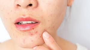 Adult Acne: 10 Surprising Causes (and How to Get Rid of It) | Everyday  Health